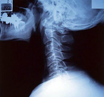 рентгенография шейного отдела позвоночника в боковой проекции, нестабильность позвоночника, смещение позвон позвонков