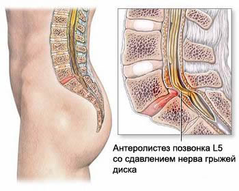 Спондилолистез позвоночника со сдавлением нерва, грыжа межпозвоночного диска, протрузия межпозвоночного диска, грыжа шморля